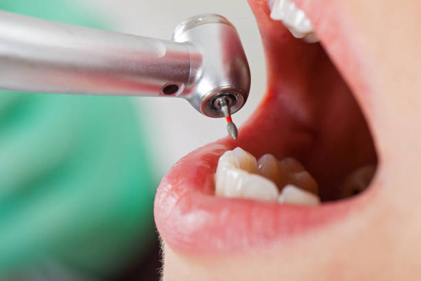 Best Emergency Dental Extractions in Newton, MS